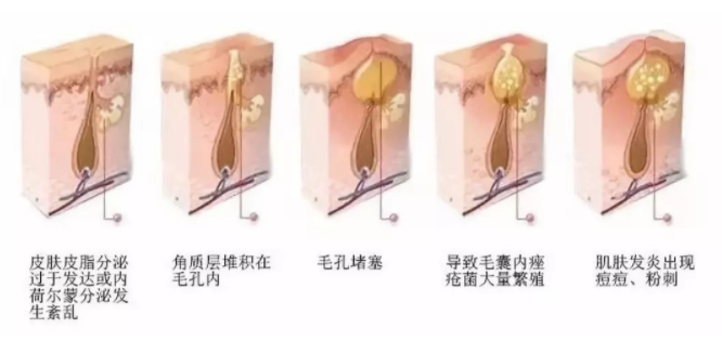 痘痘為什麼反覆長?